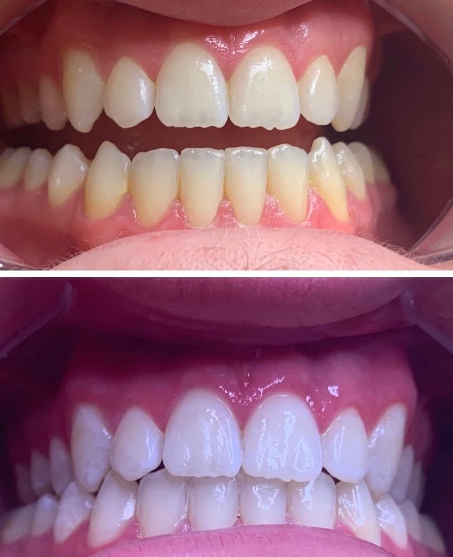 Teeth Whitening at Flawless Skye Beauty Bar